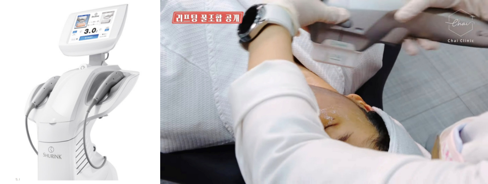 눈주름보톡스 관련 이미지 7