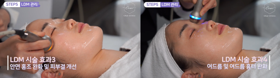 LDM물방울리프팅 효과 수분은 물론 탄력까지 찾아드려요 관련 이미지 4