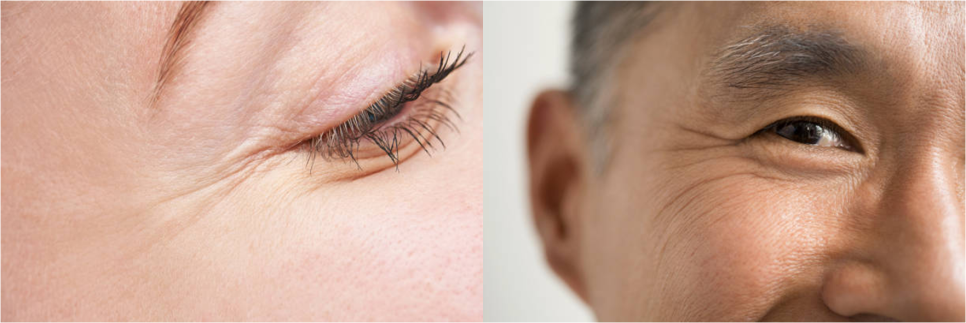 눈가 리프팅 실패 없이 효과 제대로 보고 싶다면! 관련 이미지 2