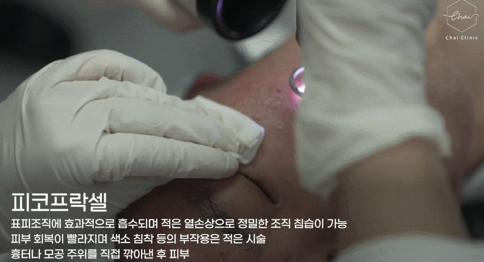 기미레이저토닝도 나에게 맞춤 관리가 필요한 이유 관련 이미지 3