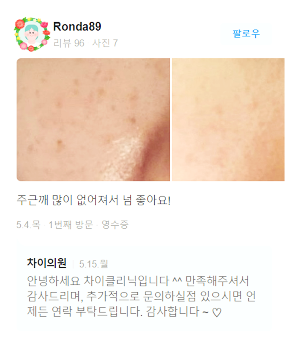 목주름레이저 타임머신효과, 탄력있는 목을 유지하세요! 관련 이미지 13