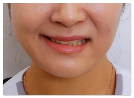 3 Things You Need to Know If You Don’t Want Botulinum Toxin Treatment in Hapjeong to Leave You Asymmetrical image 4