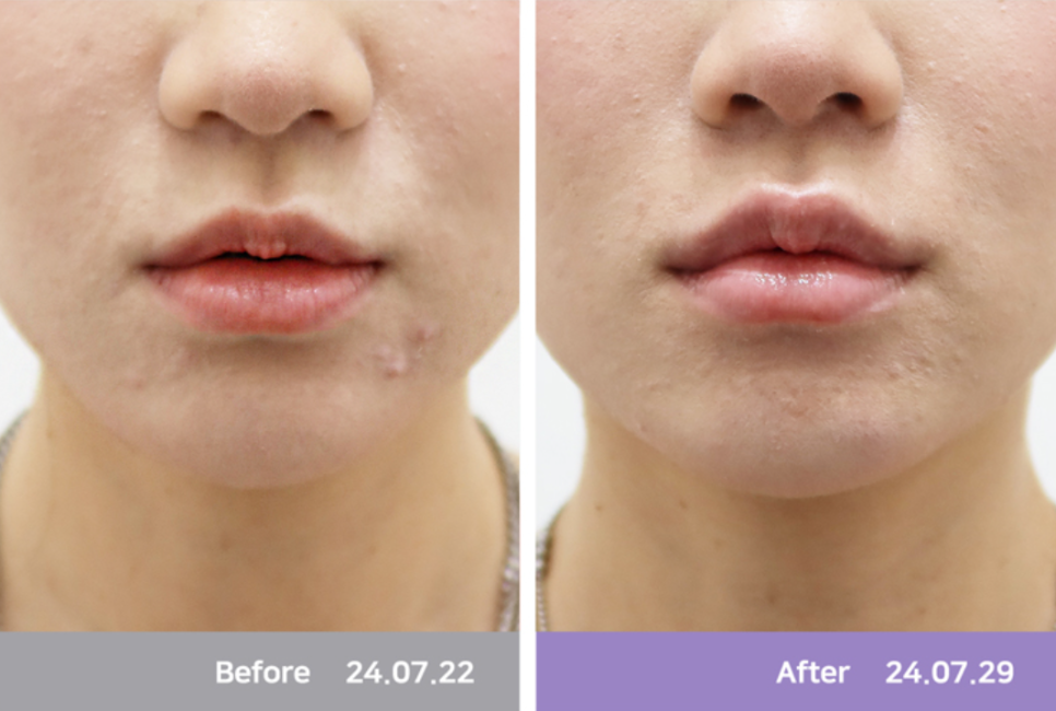 3 Characteristics of a Good Place for Lip Fillers in Hapjeong image 9