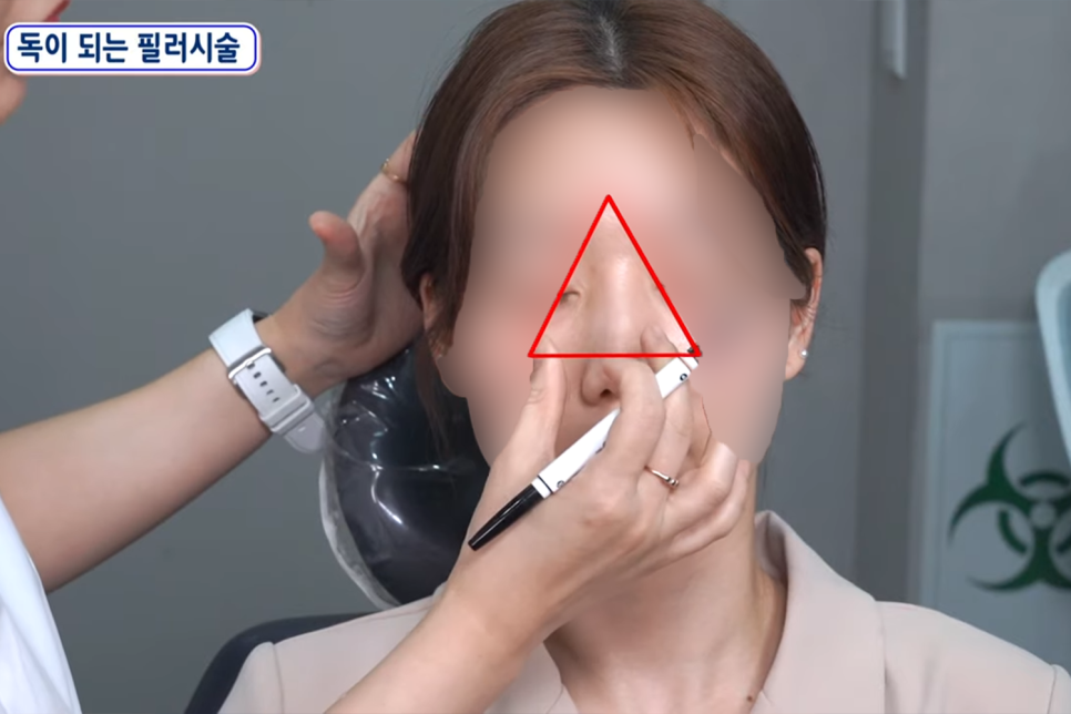 홍대 필러 유지기간은 얼마나 될까? 관련 이미지 5