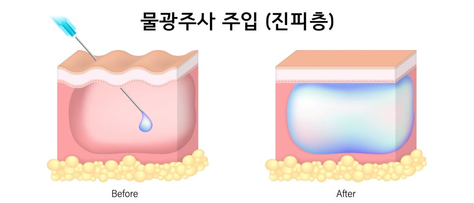 합정 물광주사 효과, 주의점 의사가 알려드려요 관련 이미지 7