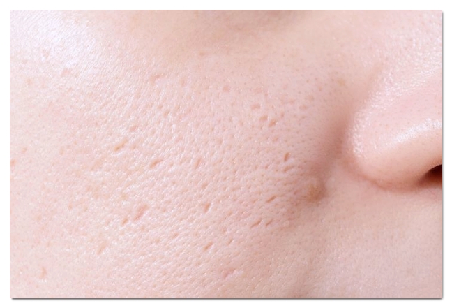 How to Get Acne Steroid Injections Effectively in Hongdae image 4
