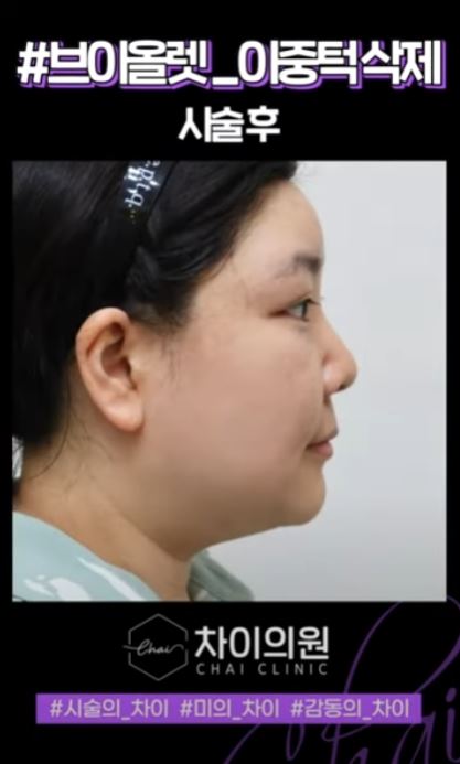브이라인시술 매끄럽고 날렵한 라인으로! 관련 이미지 8