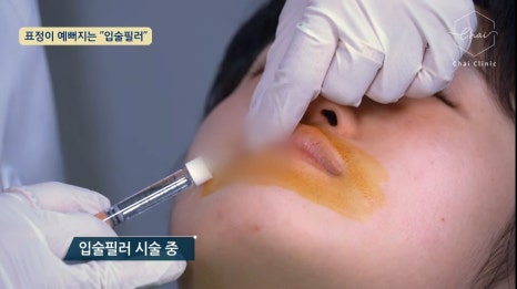홍대필러, 입술필러로 동안이미지 만들어봐요 관련 이미지 9