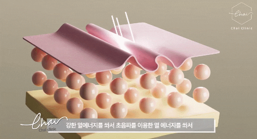 울쎄라 600샷 주목! 샷수보다 더 중요한 것은 관련 이미지 2