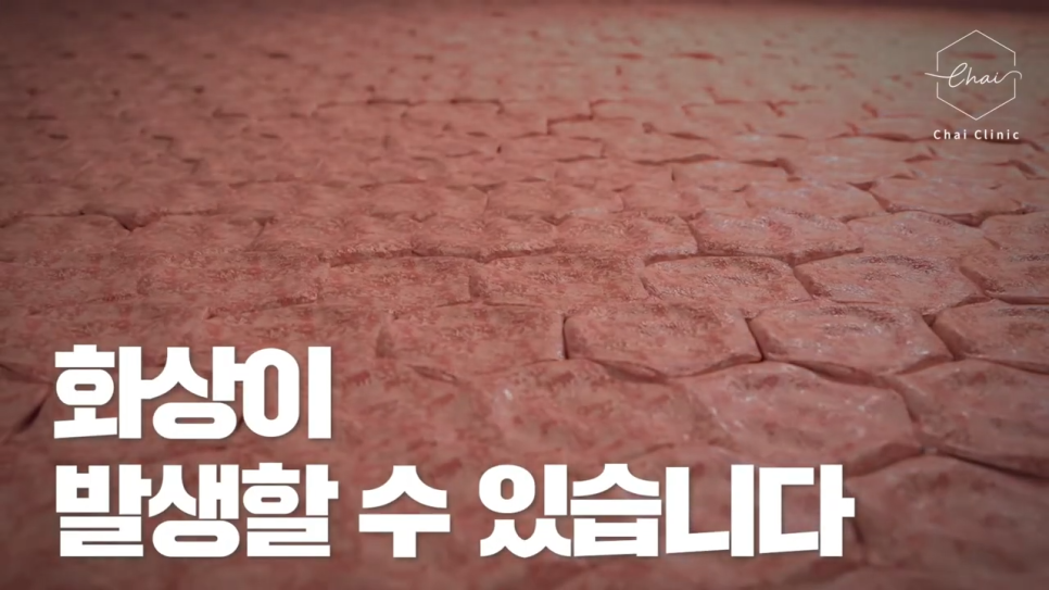 홍대 써마지 효과 보기 위해서는 반드시 알아두어야 할 내용! 관련 이미지 3