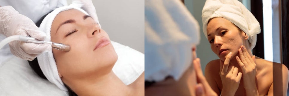 홍대여드름흉터 제거 가장 효과적인 제거 방법은? 관련 이미지 3