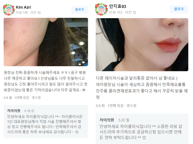 사각보톡스 불룩한 턱선을 V라인 얼굴로 관련 이미지 15