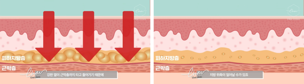 눈리프팅 효과를 120% 더 낼 수 있는 시술 대공개! 관련 이미지 7