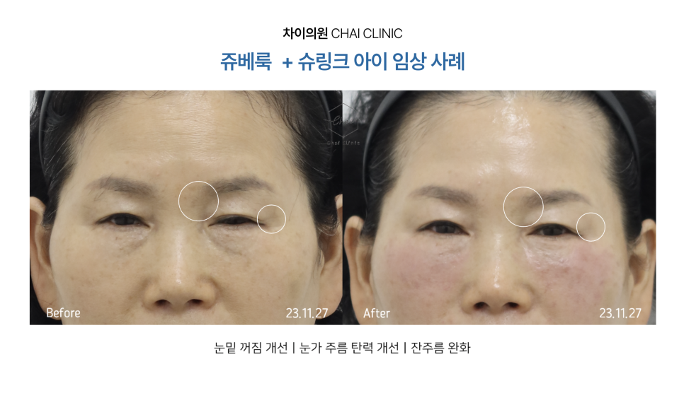 리프팅 맛집! 차이의원에서 피부 리프팅 연말 결산 해요! 관련 이미지 16