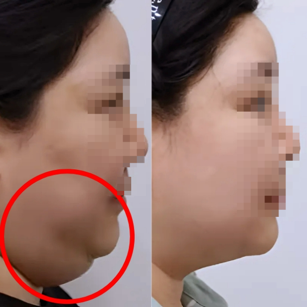 홍대 윤곽주사 효과 올리는 3가지 방법 관련 이미지 7