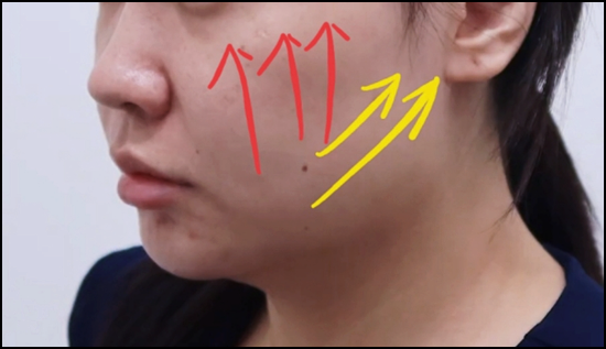 울쎄라 써마지 차이 무엇이 다를까? 관련 이미지 6