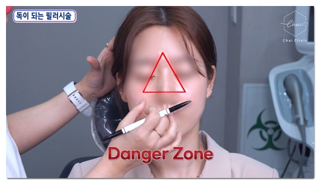 Three Steps to Prevent Filler Spreading, Migration, Necrosis, and Other Side Effects in Hongdae image 8