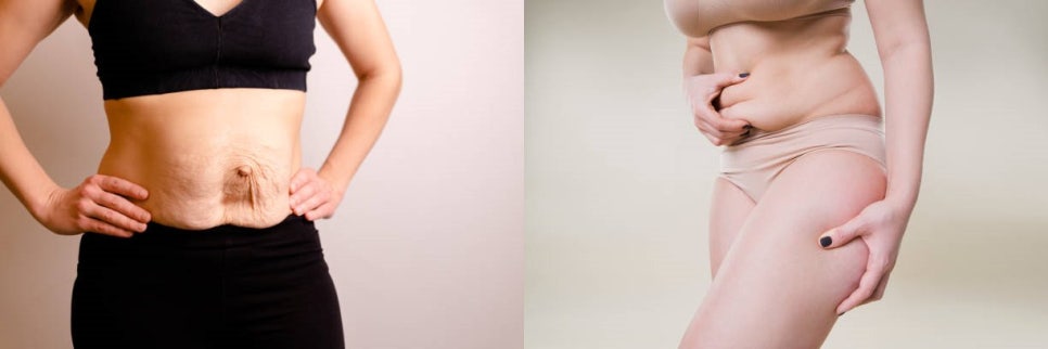 합정역몸매관리 차이의원 탄력 울핏 인스타바프 프로그램 관련 이미지 12