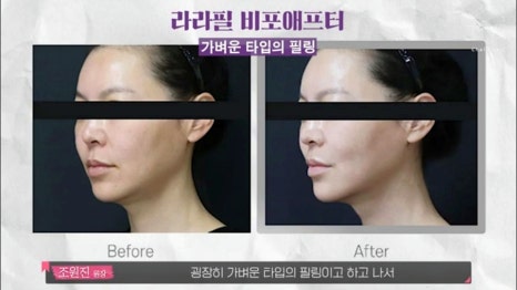 신촌역피부관리 빨리 예뻐져야 할 때 필요한 시술 관련 이미지 5