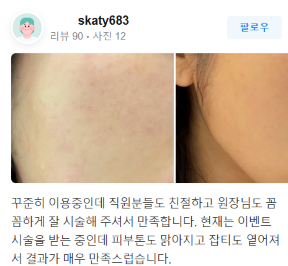 블랙헤드 피부 관리, 아피니트로 모공 청소하세요! 관련 이미지 16