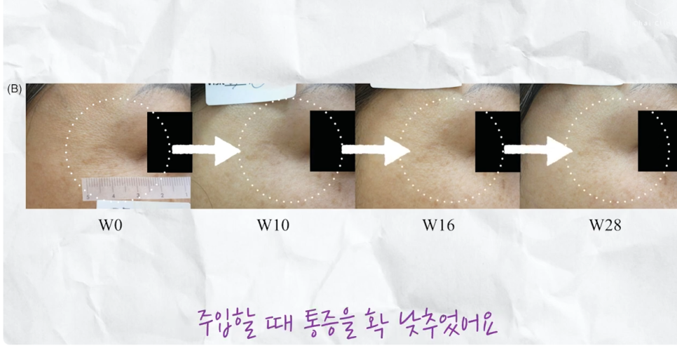리쥬란 hb 효과, 유지기간, 통증 총정리! 관련 이미지 3