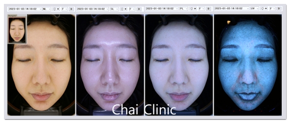 No Results from Hongdae Pico Toning? Check These 5 Things image 3