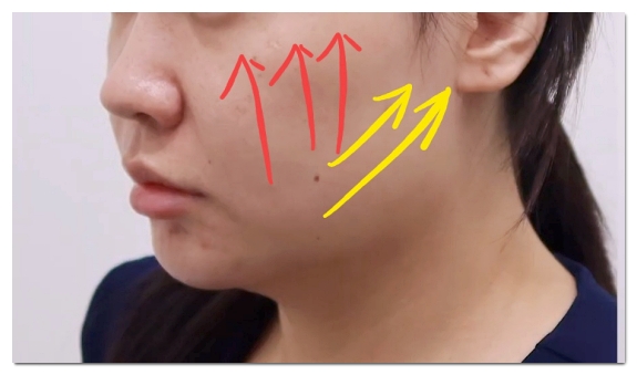 홍대 울쎄라 덜 아프고 효과 좋게 받는 방법 (수면마취 아님) 관련 이미지 7