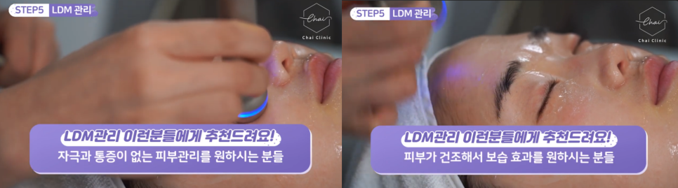 LDM물방울리프팅 효과 수분은 물론 탄력까지 찾아드려요 관련 이미지 6