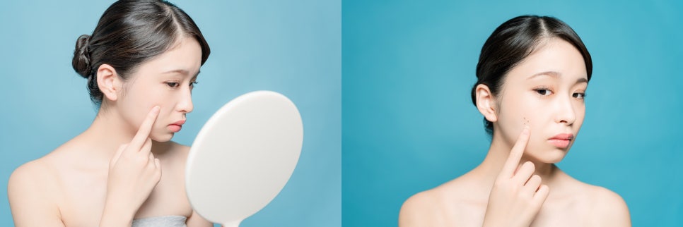 홍대 여드름 울긋불긋 붉은 피부 이제 안녕 관련 이미지 2