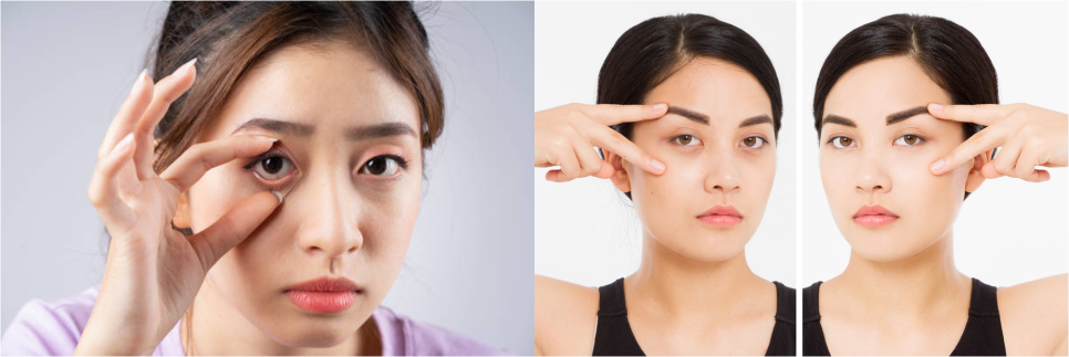 눈썹리프팅 효과 확실한 차이 느낄 수 있는 곳 관련 이미지 7