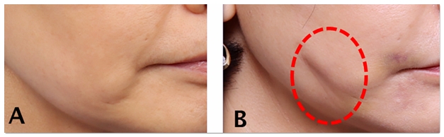 Causes of and Solutions for Side Effects After Thread Lifting in Hongdae image 2