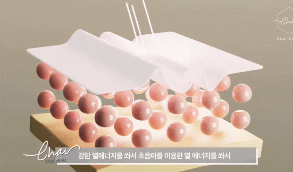 써마지울쎄라 내 피부에 어떤게 더 효과적일까? 관련 이미지 6