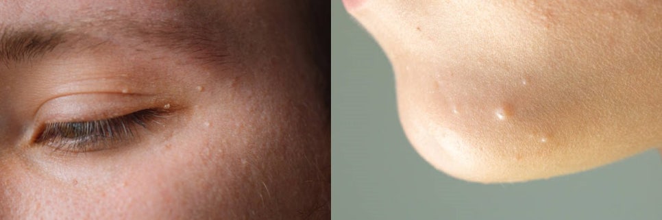 얼굴 빽빽하게 뒤덮은 사마귀 레이저로 박살 내기 관련 이미지 3