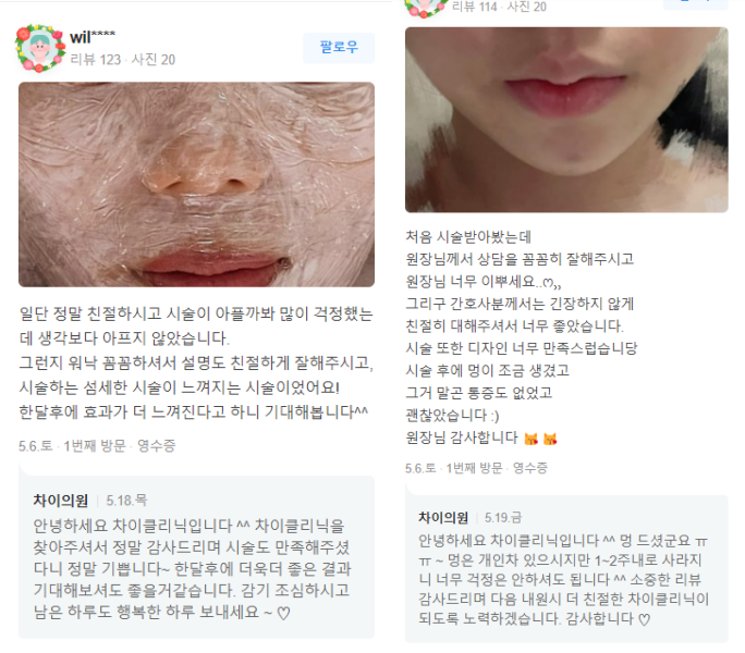 입가주름보톡스 알고 맞으면 효과 2배! 관련 이미지 17