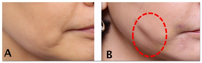 Avoid These 3 Types of Thread Lifting Side Effects in Hongdae image 4