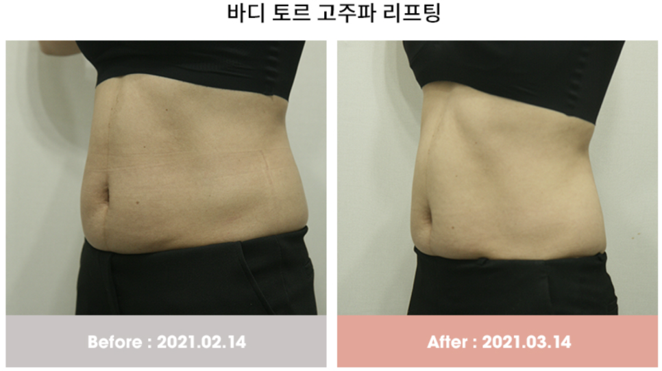 홍대 지방분해주사 복부, 팔뚝, 이중턱 시술 결과는? 관련 이미지 5