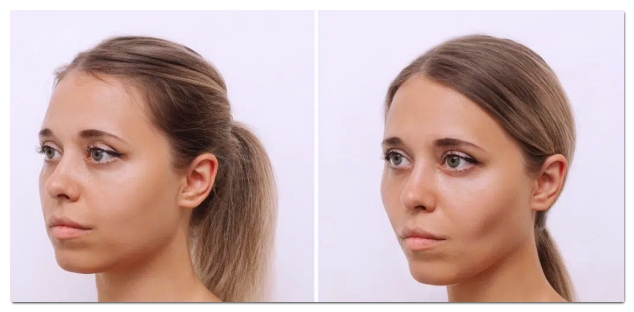 Criteria for Choosing a Good Ulthera Clinic in Hongdae image 2