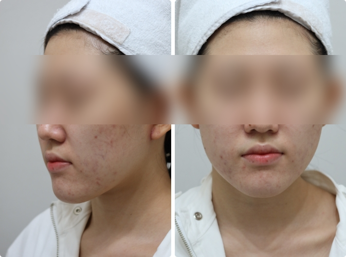 여드름흉터피부관리 관련 이미지 4