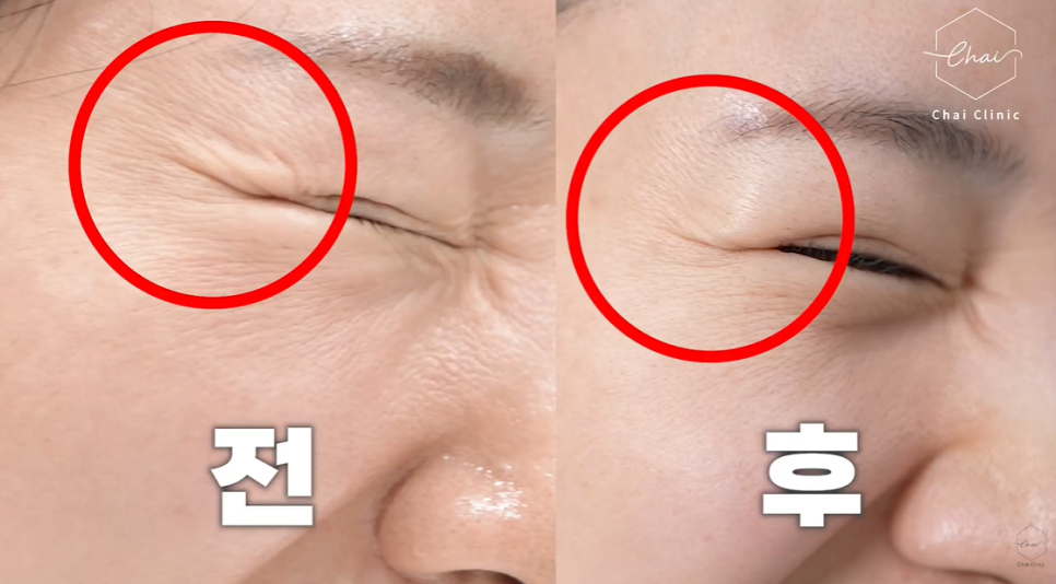 3 Ways to Get the Most Out of Shurink in Hapjeong, Just Like Ulthera image 6