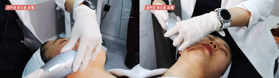 홍대인모드 요즘 가장 핫한 리프팅 시술 효과도 핫하려면? 관련 이미지 9