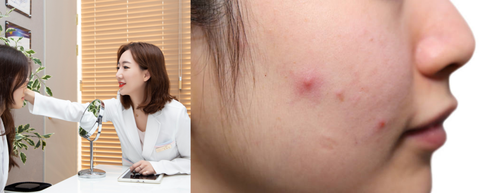 연남동피부관리, 지우개로 쓱싹! 여드름 치료하기 관련 이미지 1