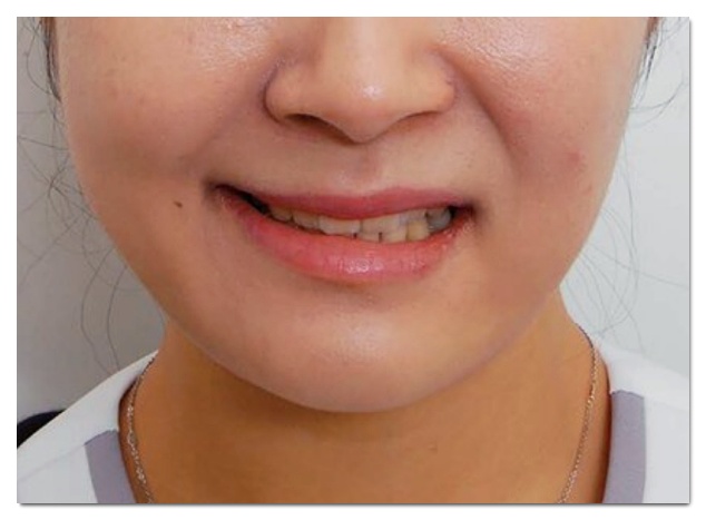 Hongdae Jaw Botox: A Complete Guide to Side Effects That Can Occur While Reducing Jaw Muscles image 8