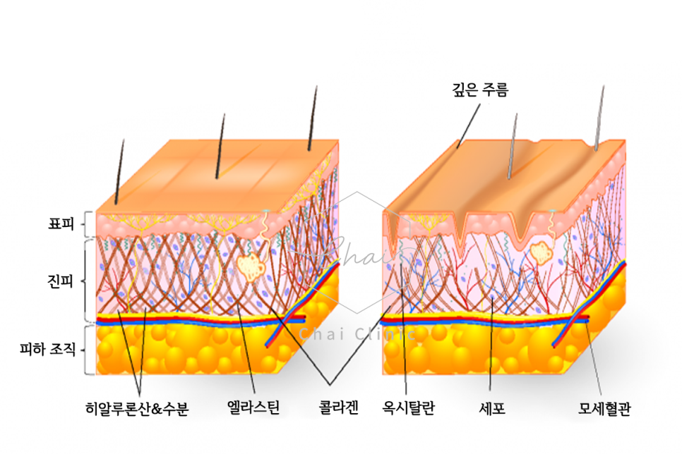 망원 리프팅 종류와 부작용 알고 시작하세요 관련 이미지 2