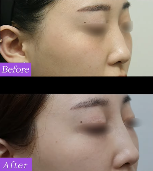 Hongdae Nose Filler Side Effects: Don’t Regret It — Get It Done Like This image 6