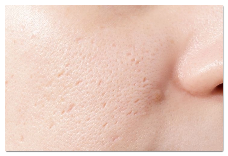 3 Things to Check When You Need an Anti-Inflammatory Acne Injection in Hongdae, Urgently image 5
