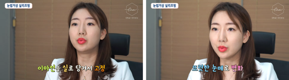 합정실리프팅잘하는곳 찾으려면 관련 이미지 2