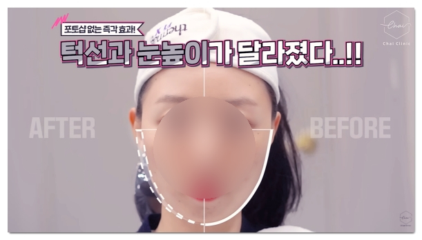 Three Major Side Effects of Hongdae Shurink and How to Fix Them image 6