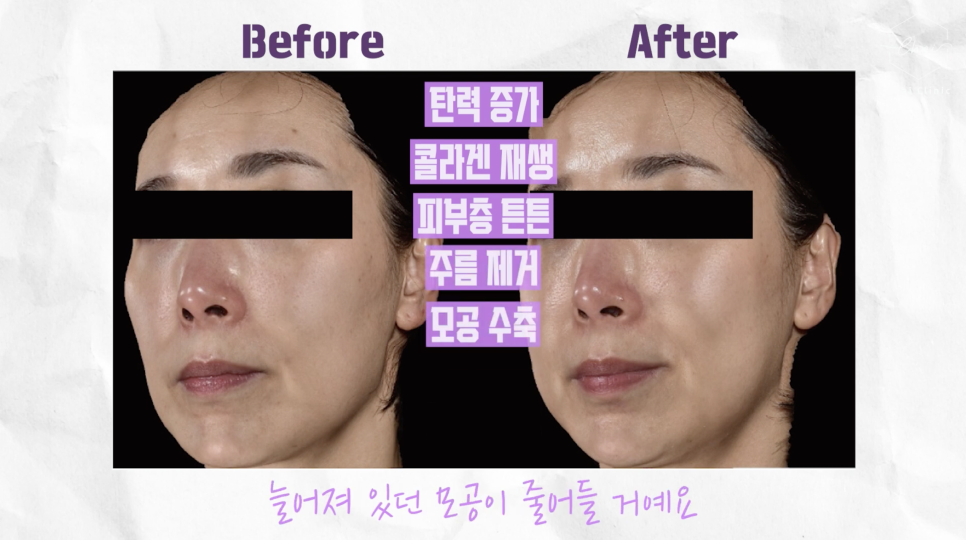 합정피부관리 차이의원의 단계별 체계적인 쥬베룩 흉터 치료 관련 이미지 2