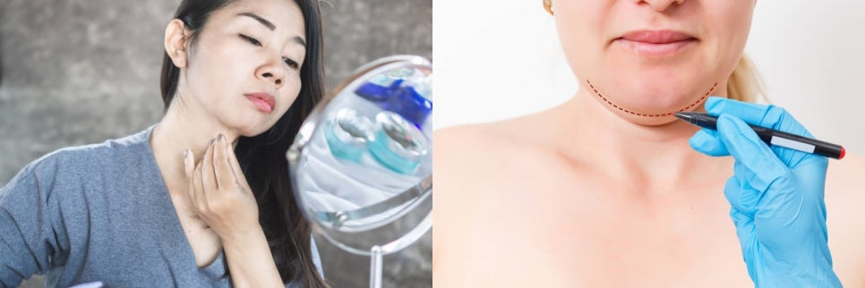 브이라인시술 매끄럽고 날렵한 라인으로! 관련 이미지 3