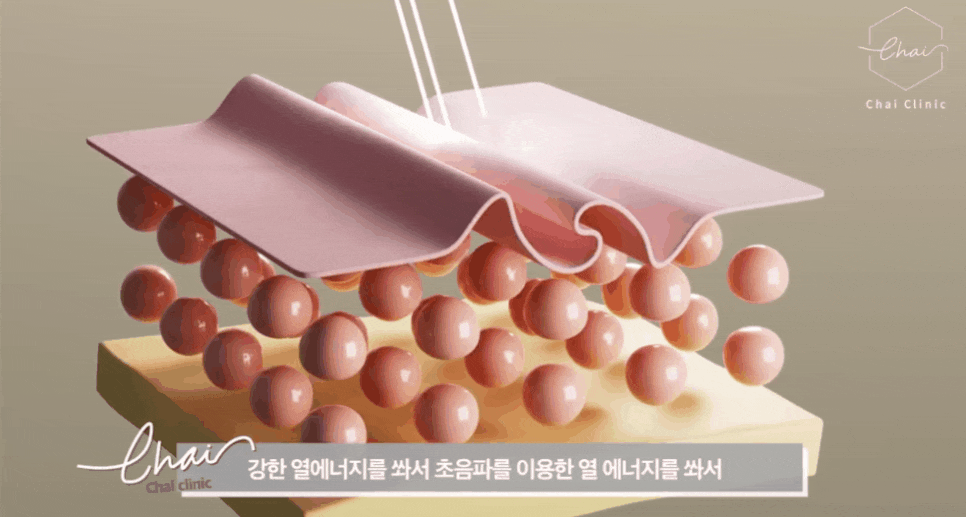 울써마지 붓기 걱정과 효과에 대해 알아보기 관련 이미지 4